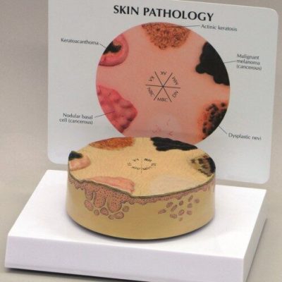 Skin Cancer Model